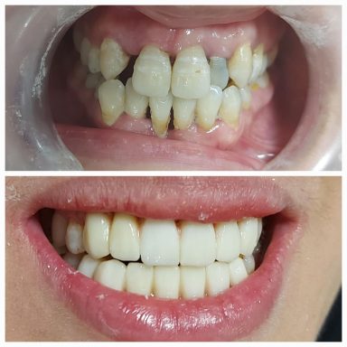 Before and after photos of teeth, showing significant whitening and alignment improvement.